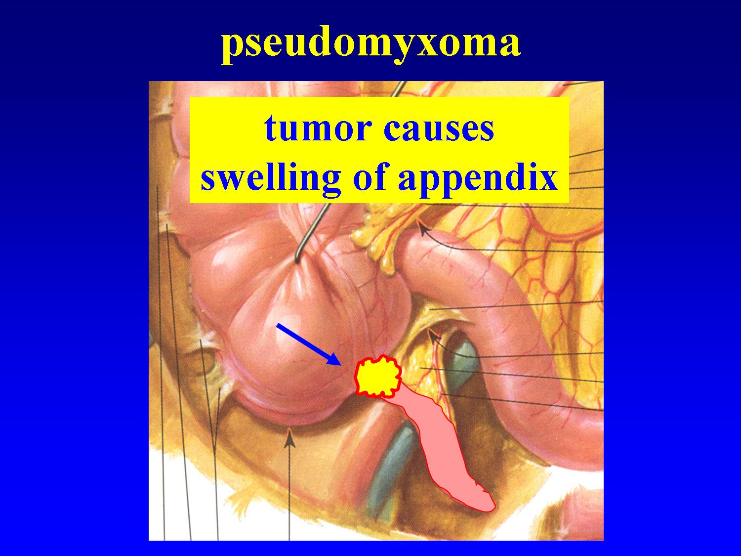 HIPEC OVHIPEC PMP peritoneal cancer peritoneum seeding seedings